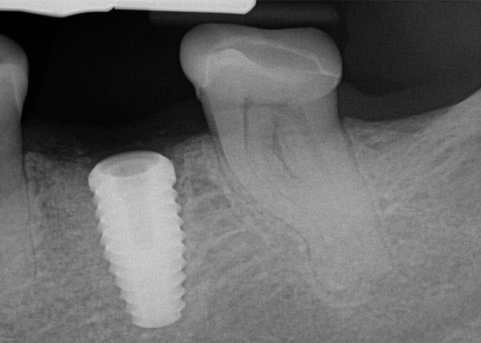 x-ray dental implant of a metal piece inside of a jaw