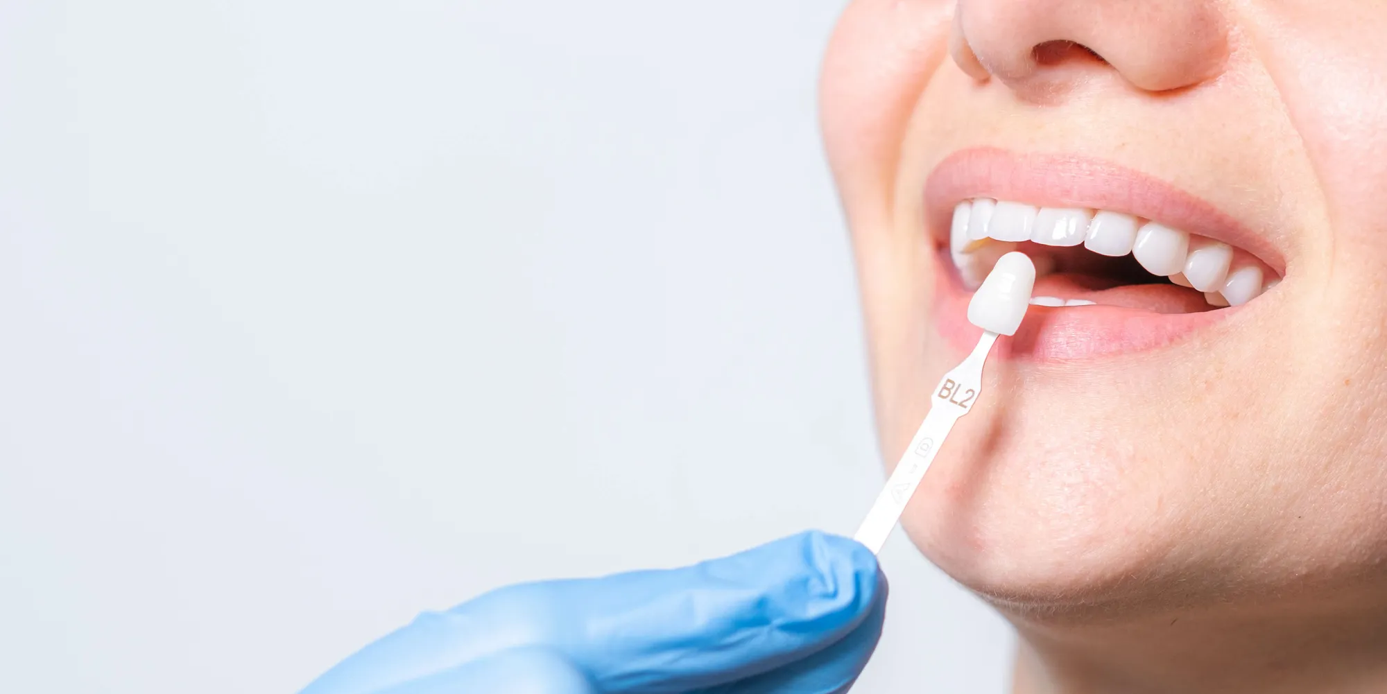 Close-up of a porcelain veneer shade sample being held up to a patient’s smile.