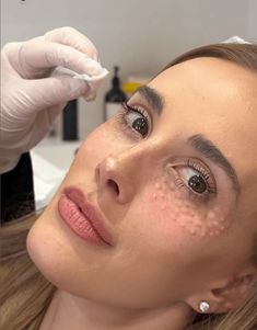 A dermatologist performing a Rejuran treatment on a woman; small injection marks are visible on her cheeks