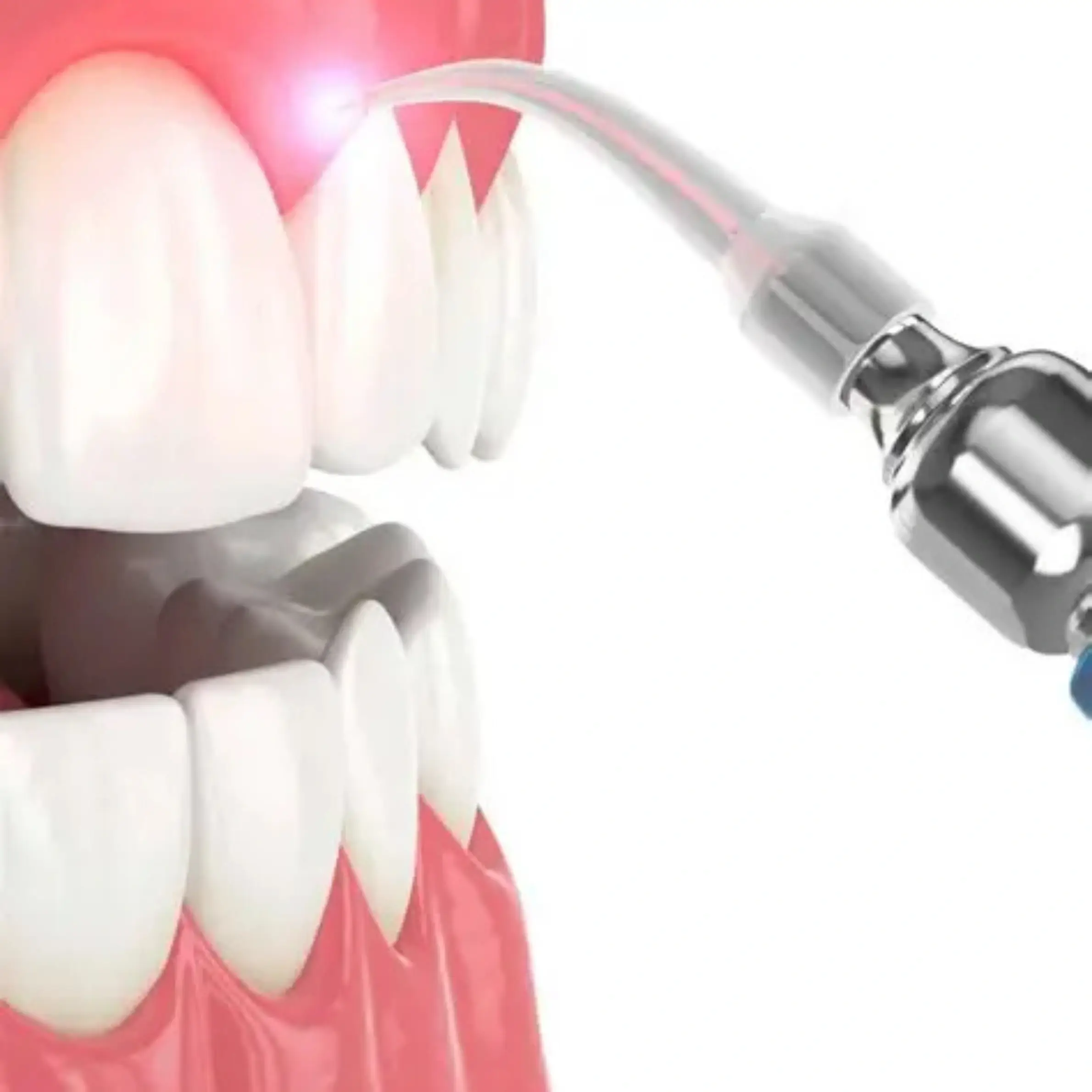 Bellingham Laser Bacterial Reduction (LBR) at The Local Dentist