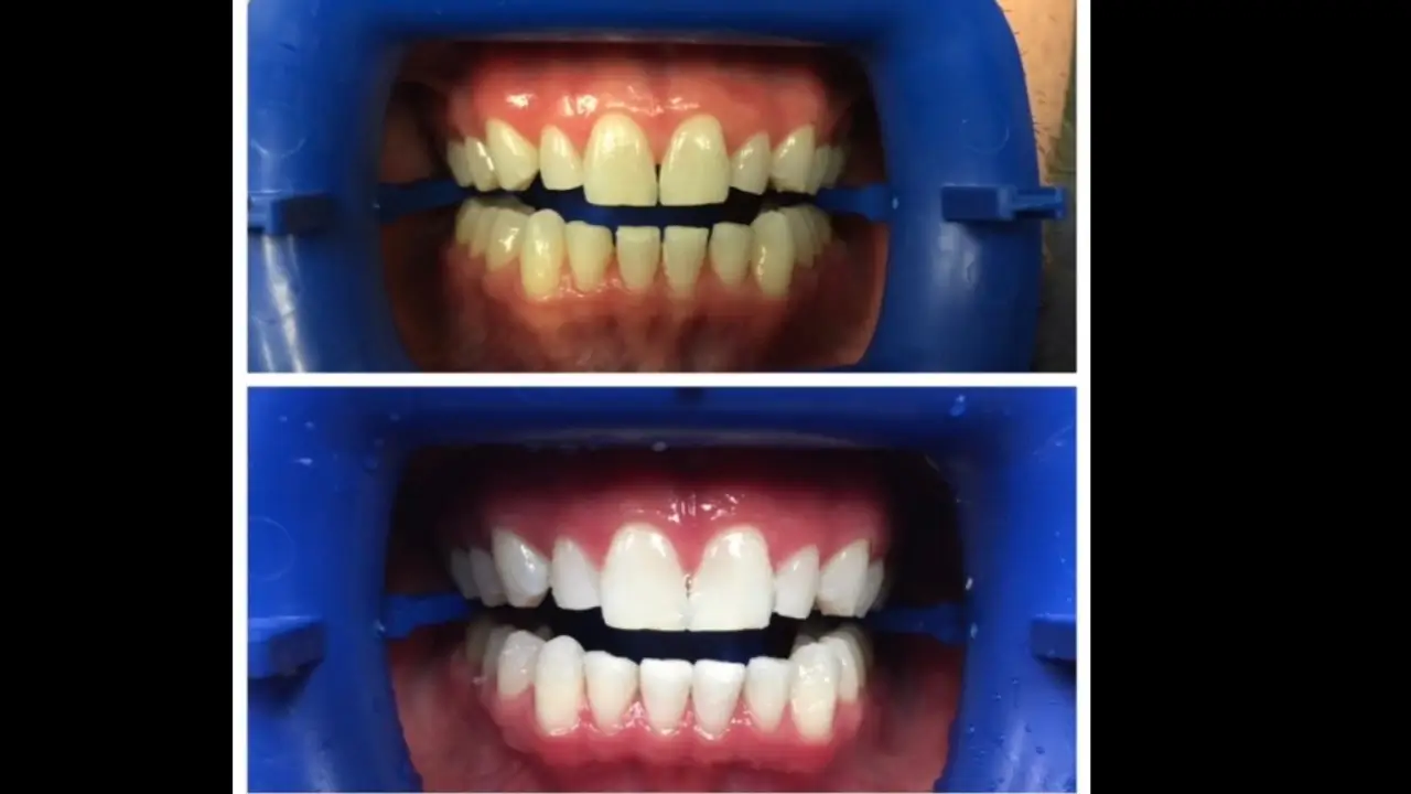 Teeth Whitening in Bellingham | The Local Dentist