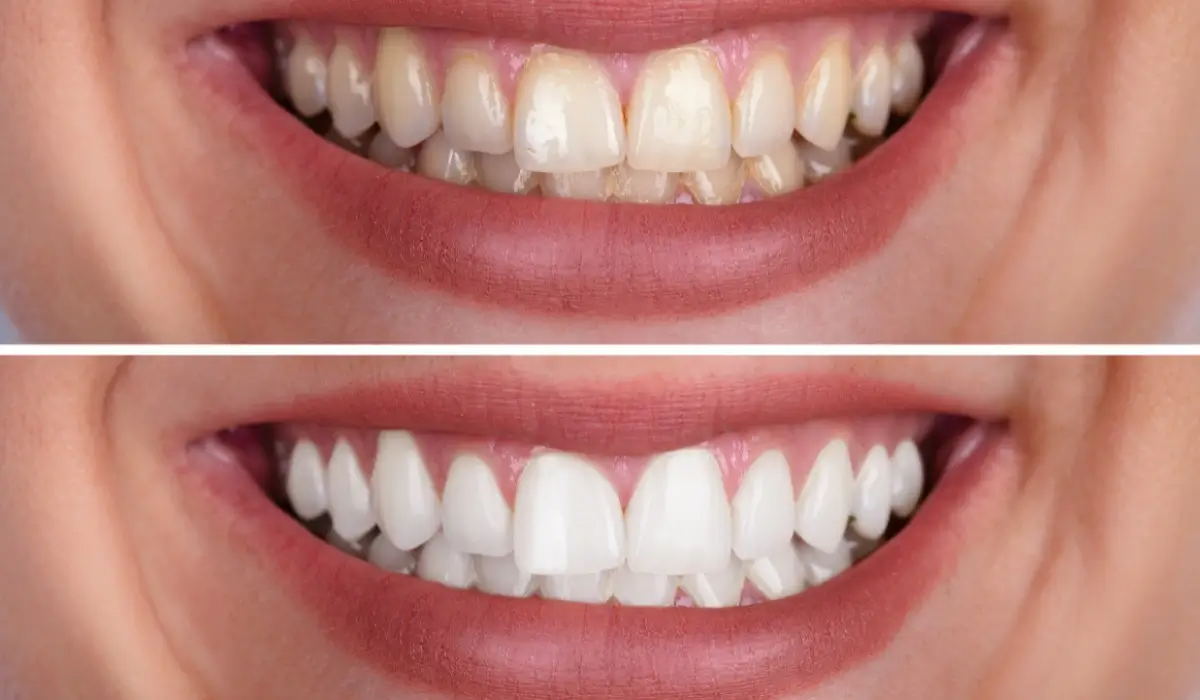 Your Guide to Teeth Whitening in Bellingham, WA: What Actually Works