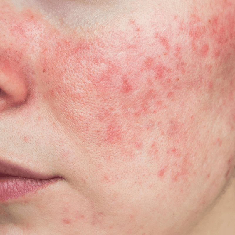 Rosacea