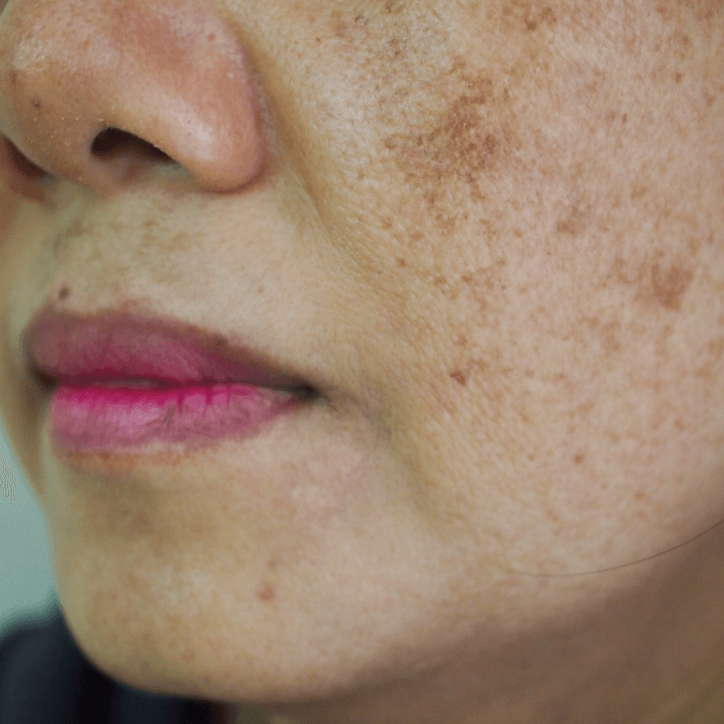 Melasma