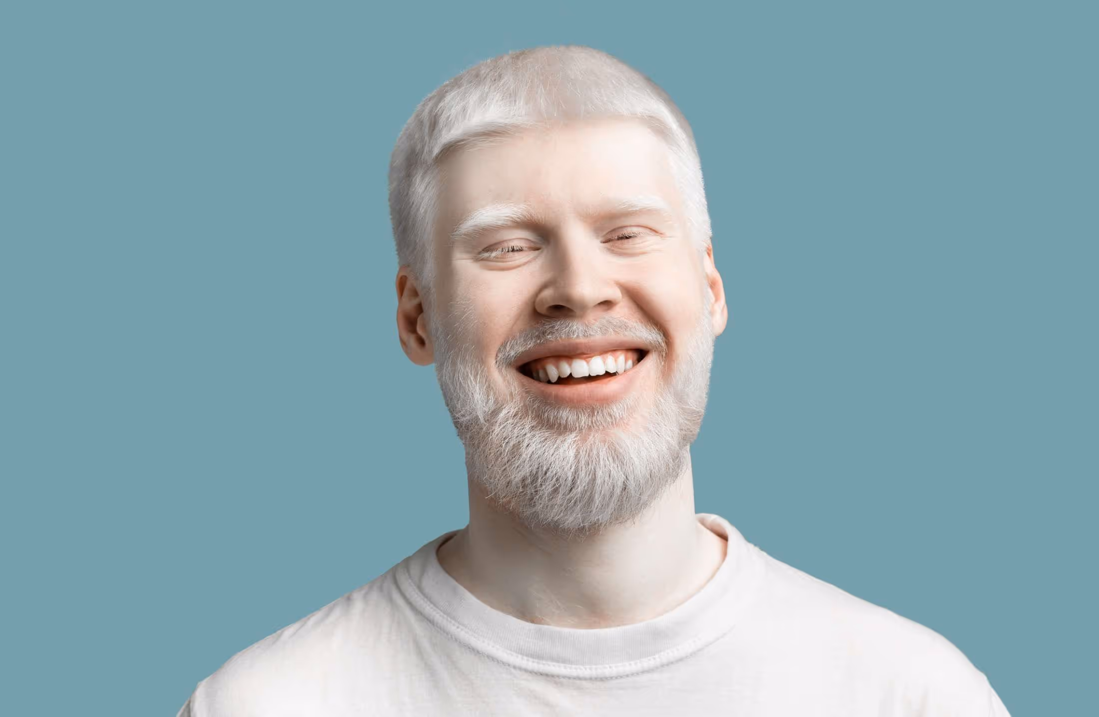 Albinismo: tire todas as suas dúvidas sobre o assunto