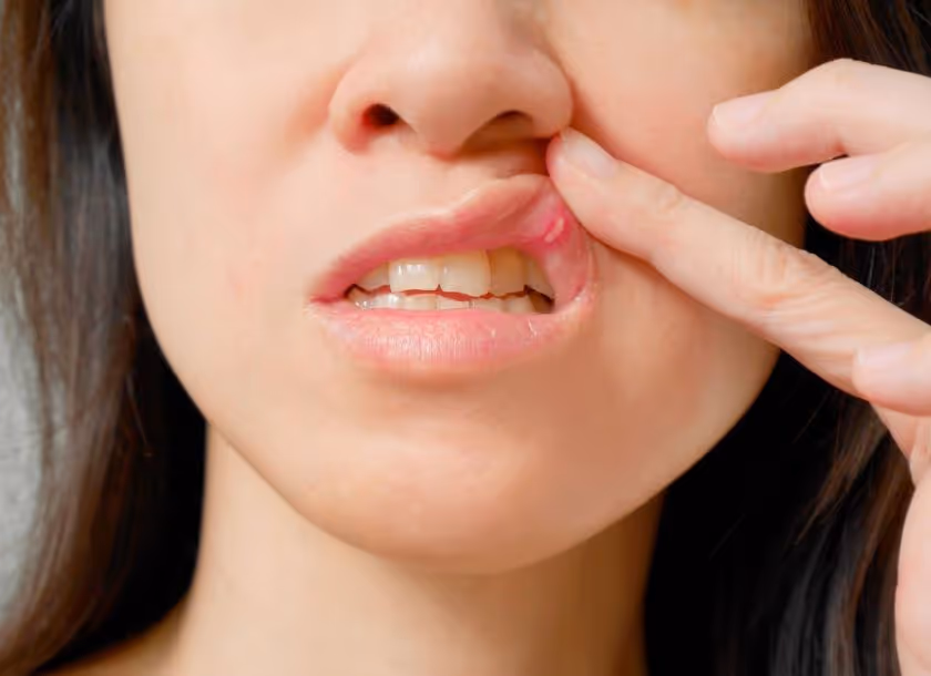 Candidíase pode afetar pele, boca e esôfago: saiba mais!