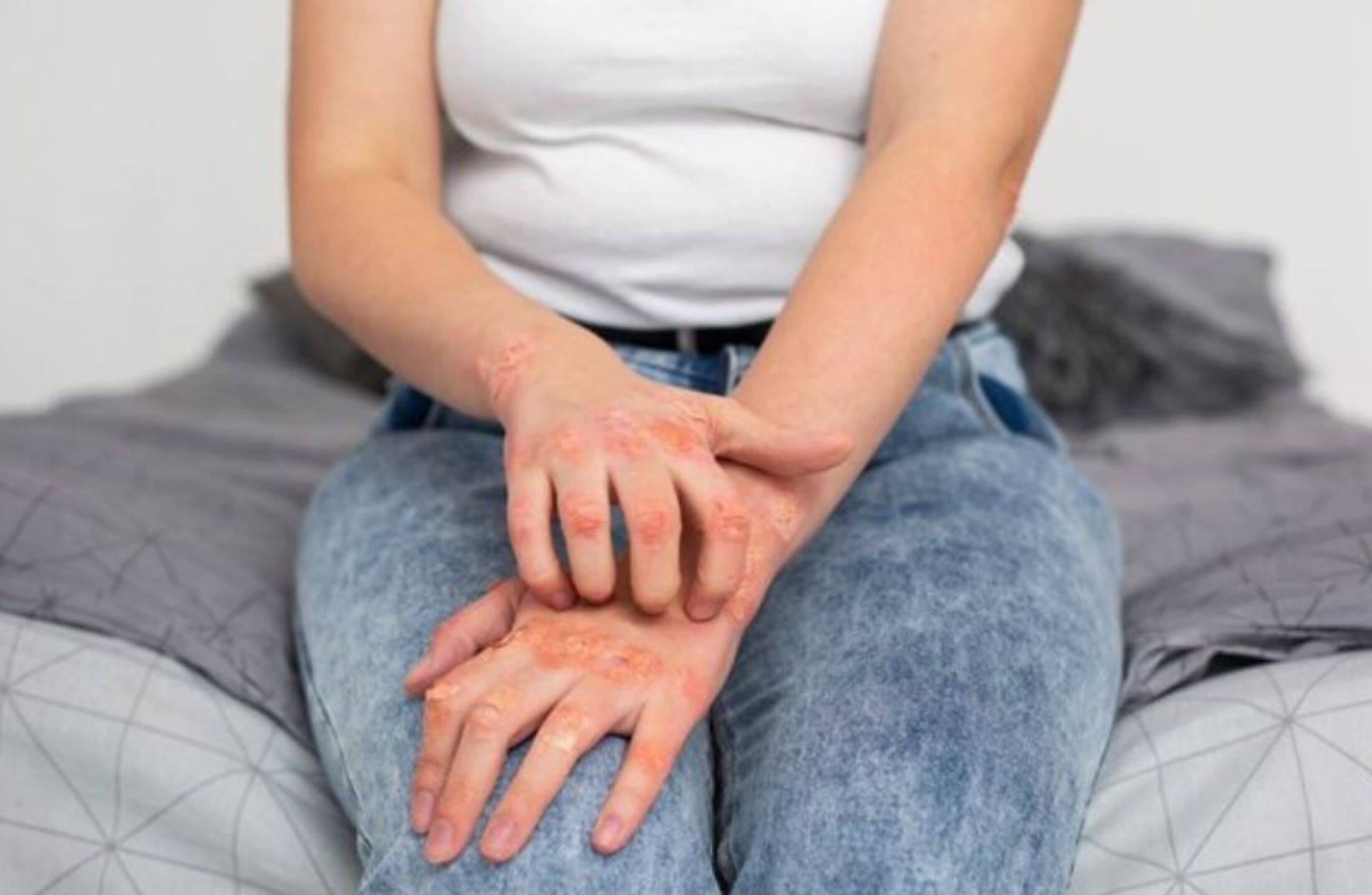 Aumento da sífilis no Brasil: causas, tratamento e prevenção