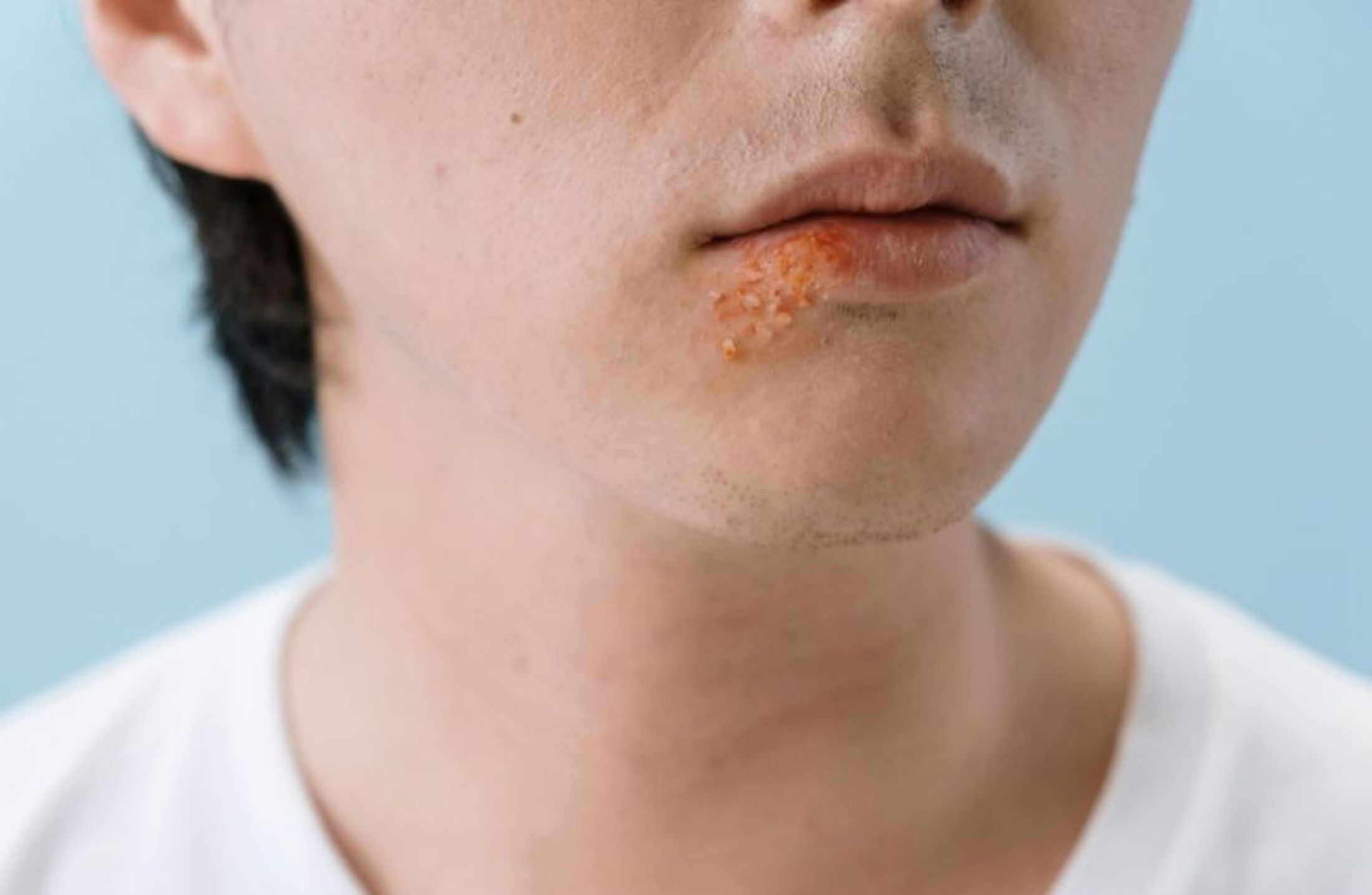 Herpes Zoster: como reconhecer, tratar e prevenir complicações