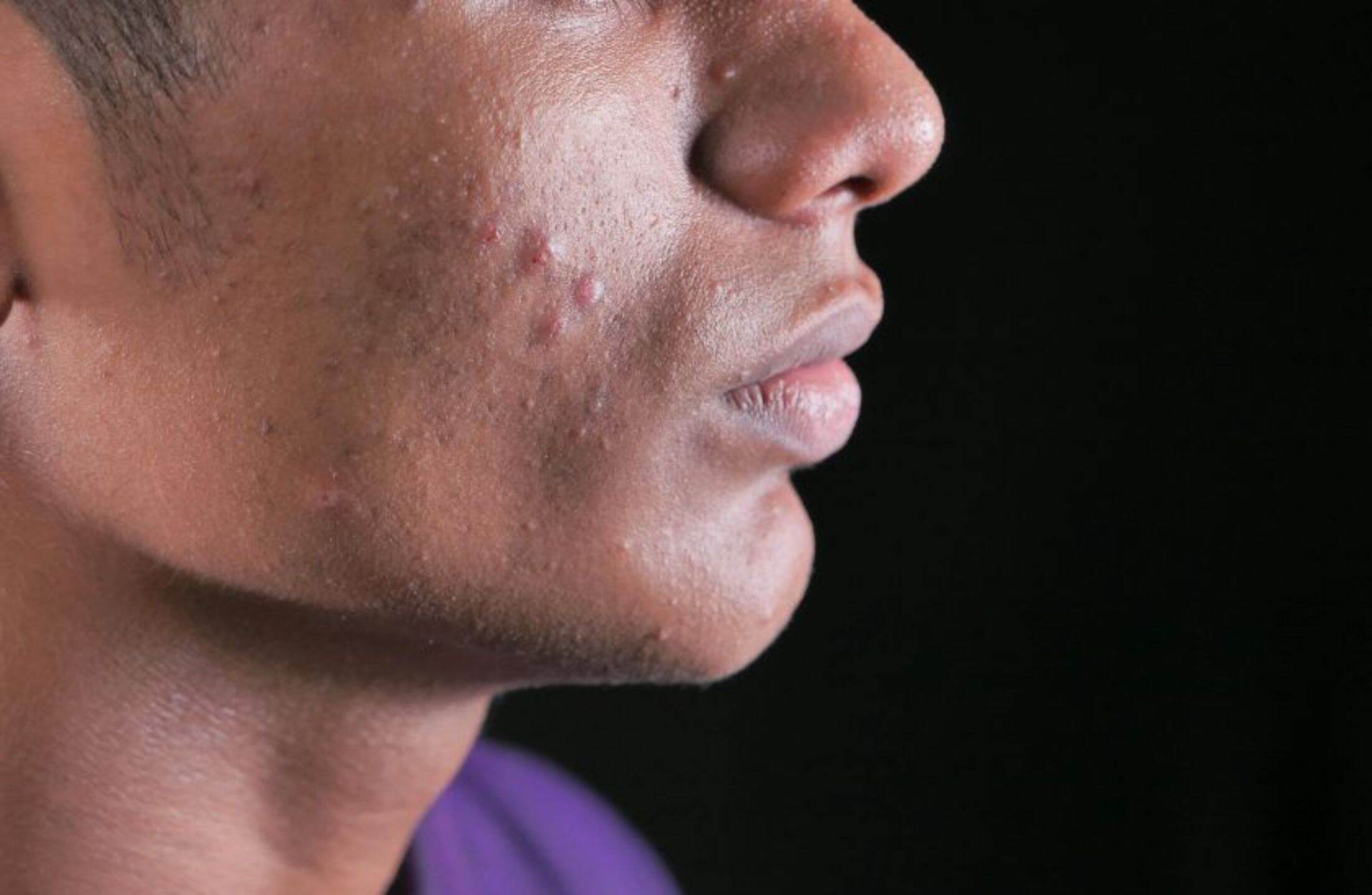 Roacutan: guia completo sobre uso, efeitos e cuidados