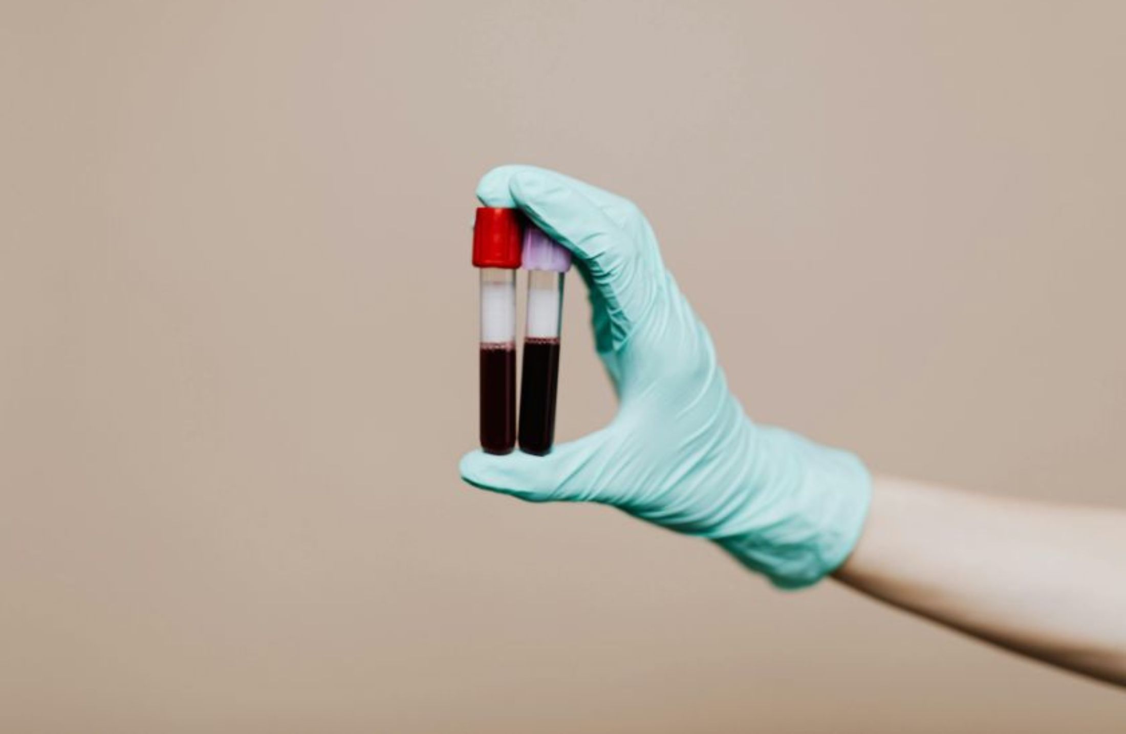 Anemia: tipos, diagnóstico laboratorial e condutas na Medicina atual