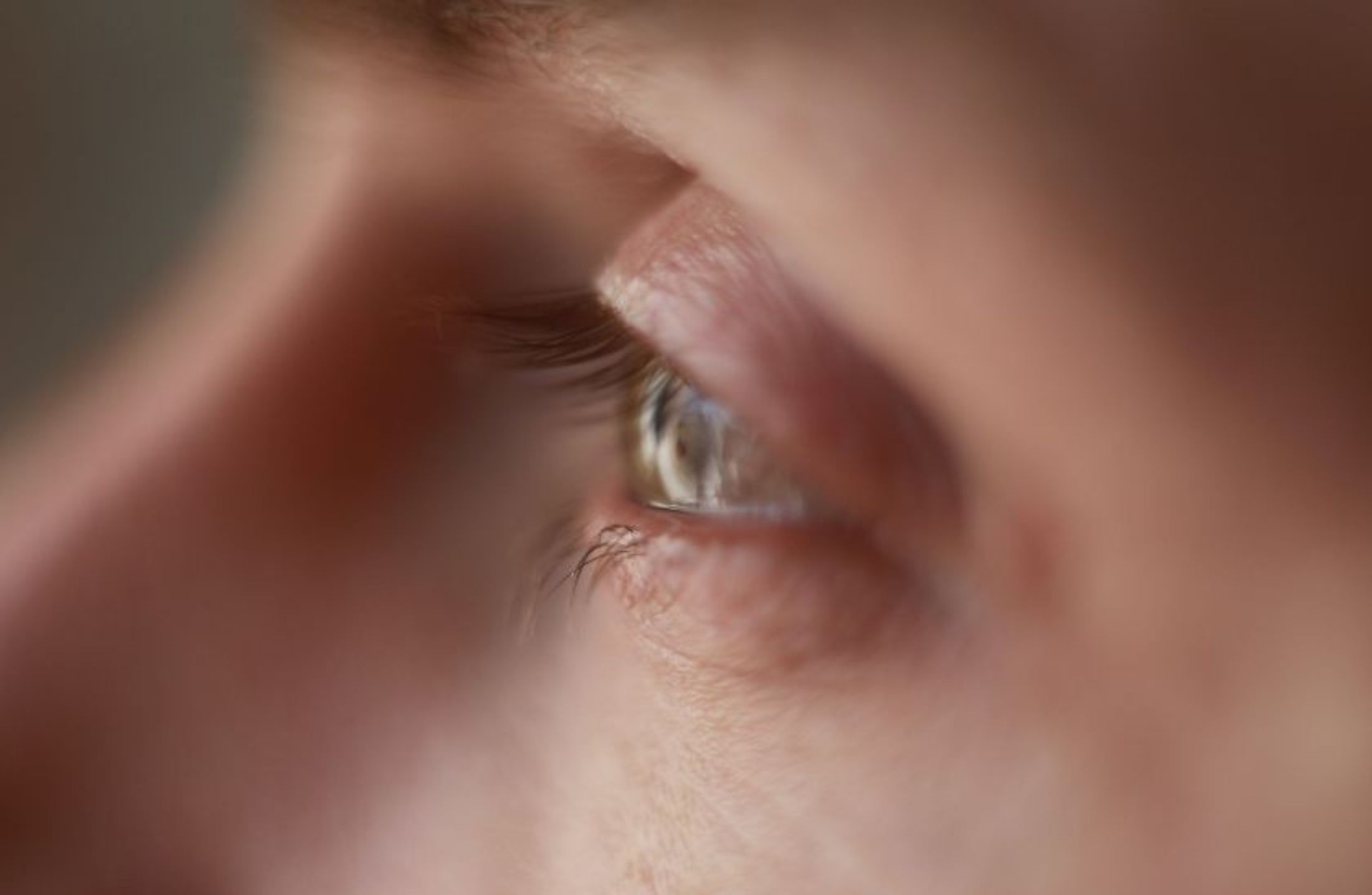 Glaucoma: o que é, sintomas, diagnóstico e tratamento