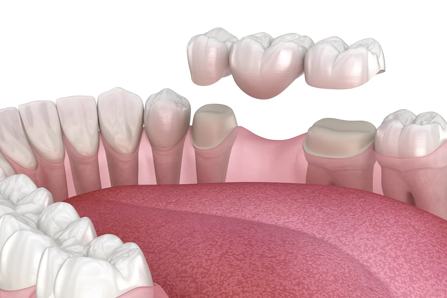 Dental Bridges: How This Fixed Restoration Fills Gaps and Restores Your Smile