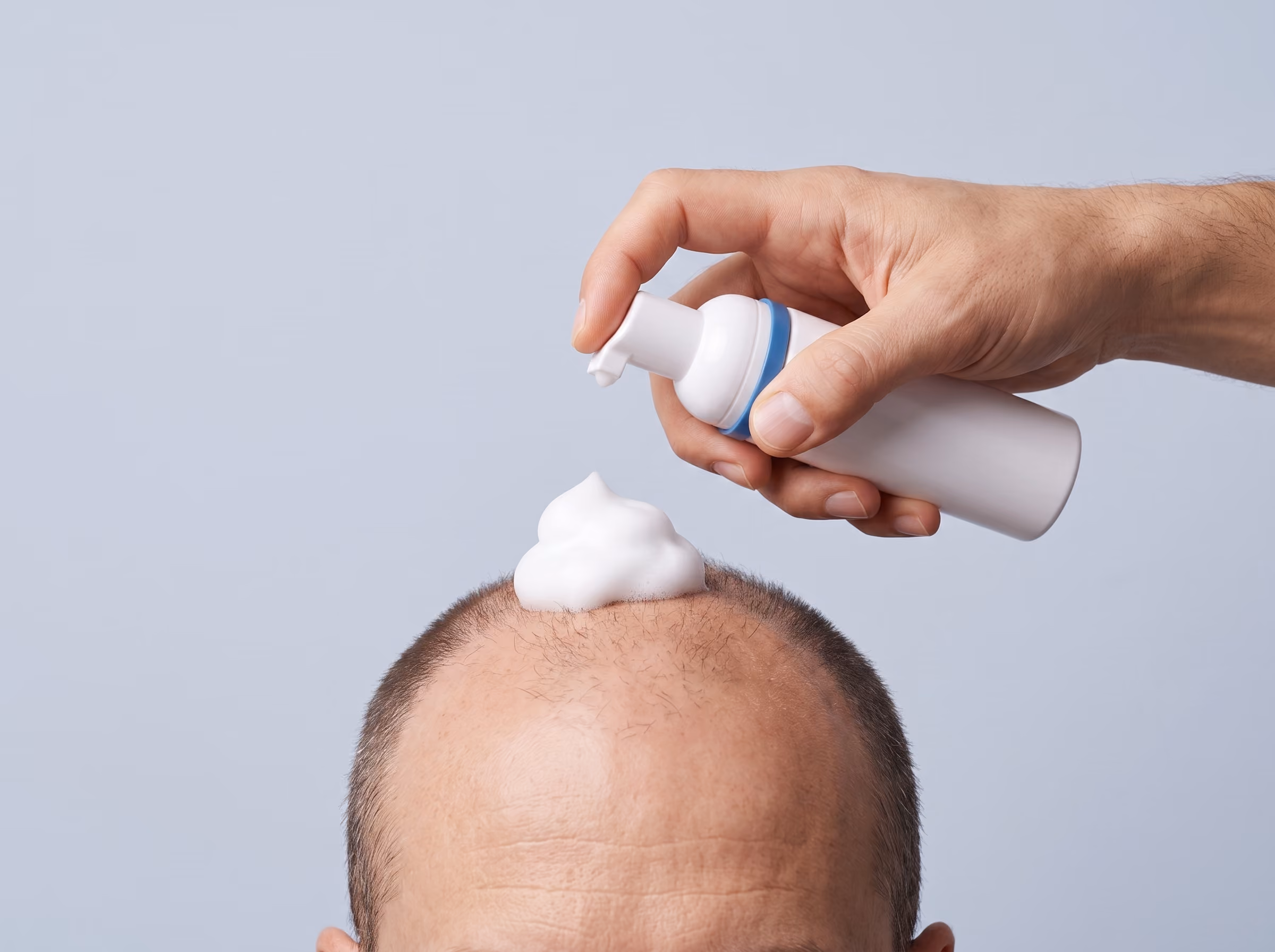 Multiple hair loss ingredients combined into one compounded preparation