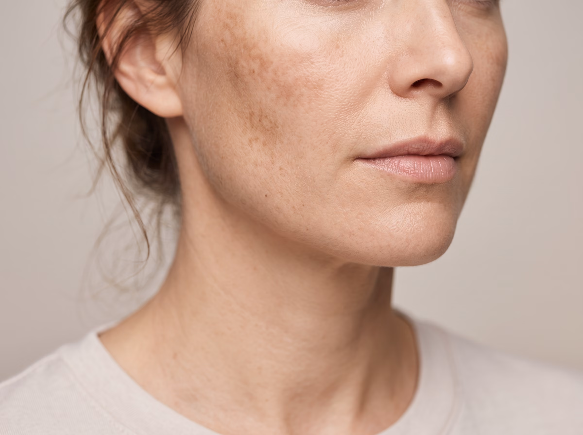 Compounded brightening cream for melasma and dark spots
