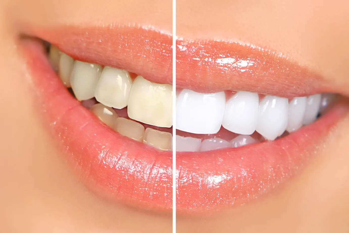 Teeth Whitening in Helotes | Kinard Family Dental