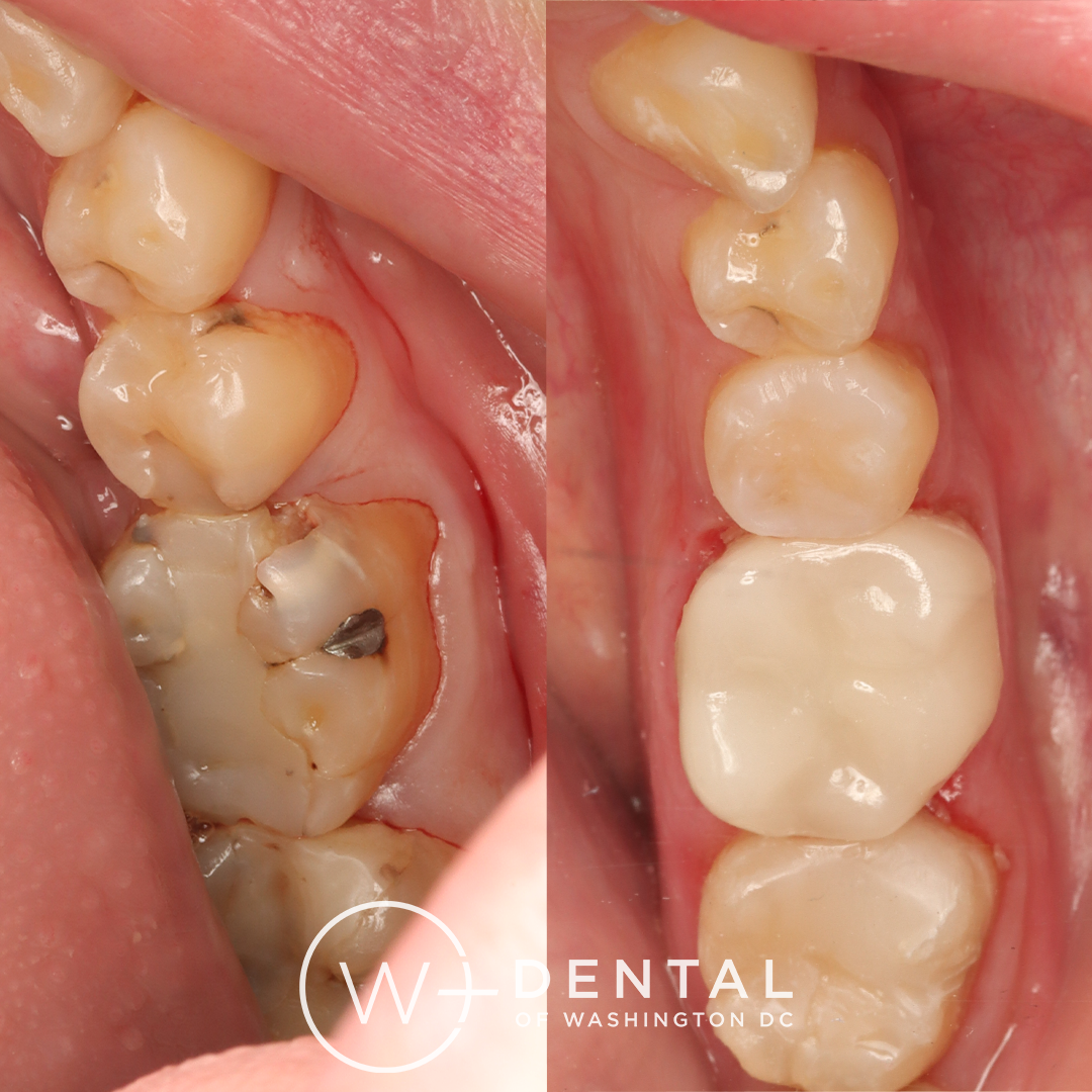 before and after dental bonding for a chipped tooth