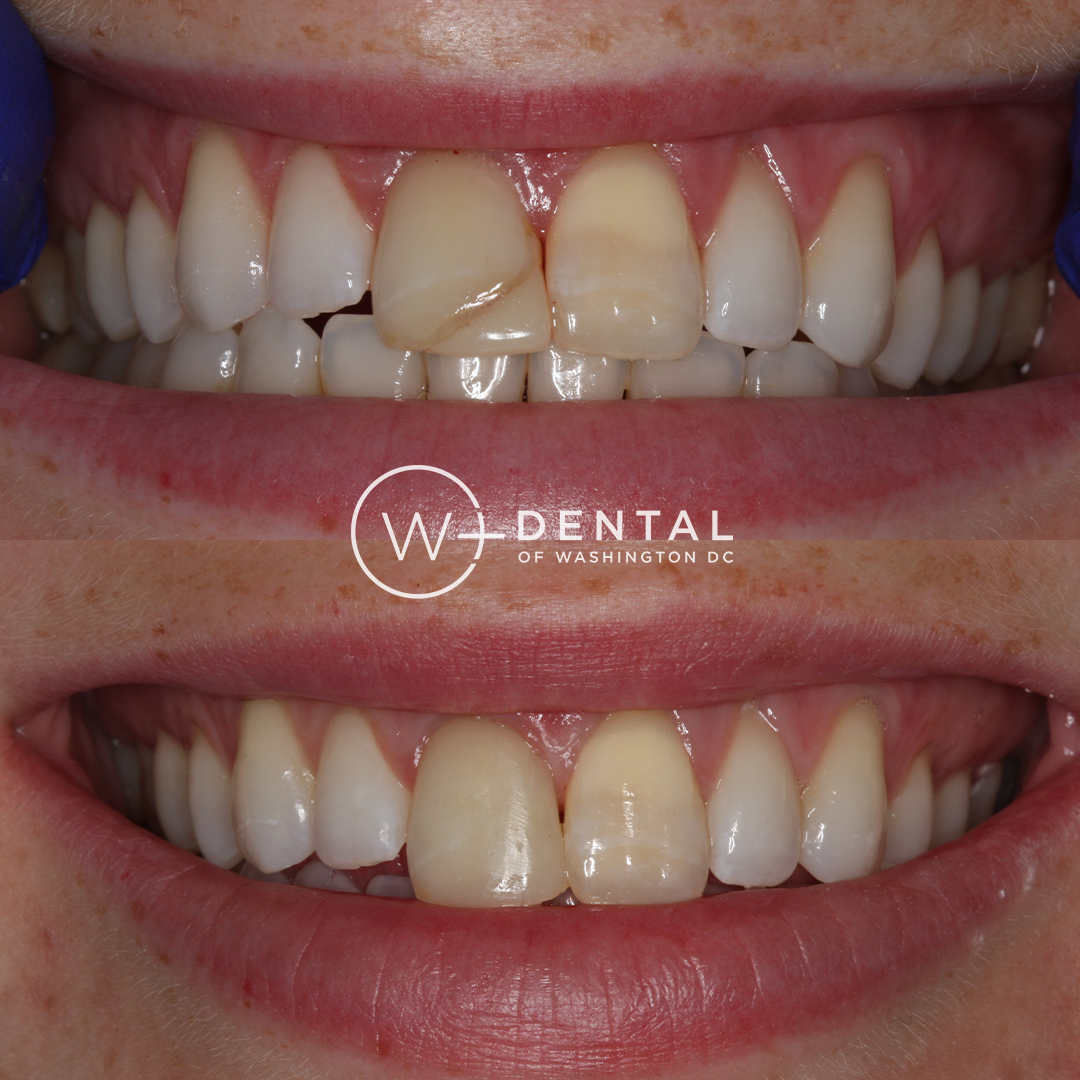 before and after dental bonding for a chipped tooth