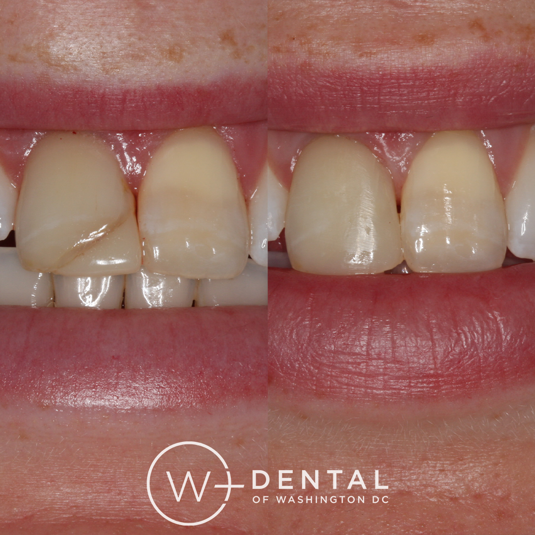 before and after dental bonding for a chipped tooth