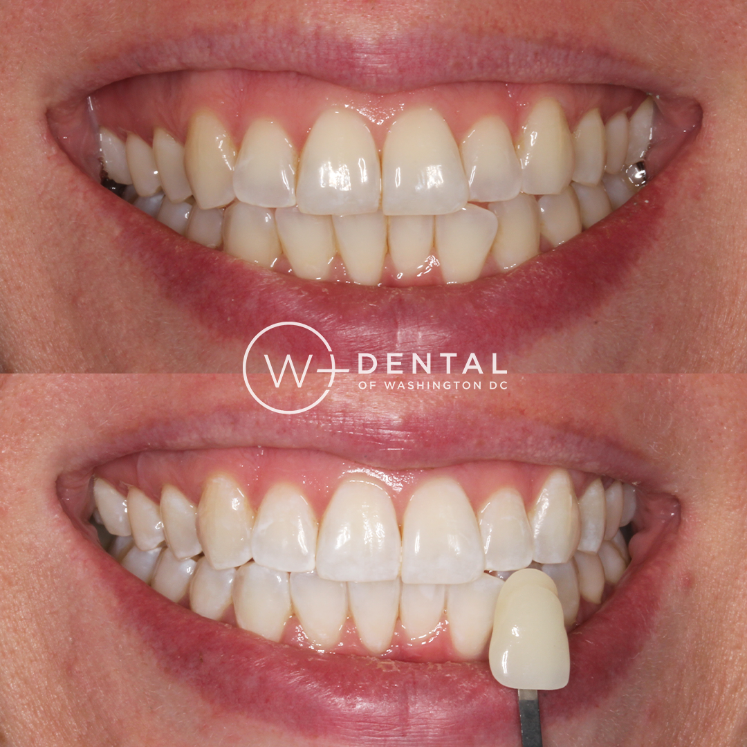 before and after dental bonding for a chipped tooth