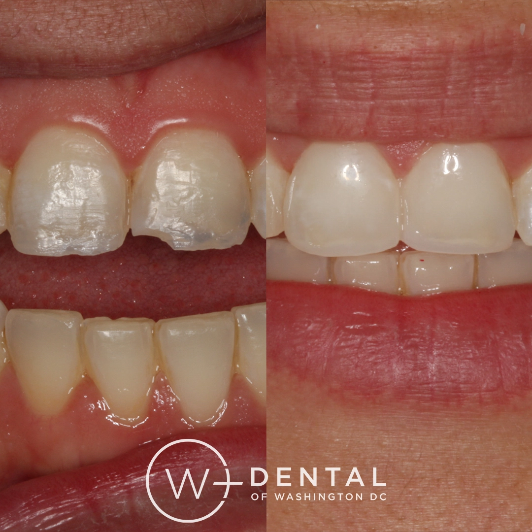 before and after dental bonding for a chipped tooth