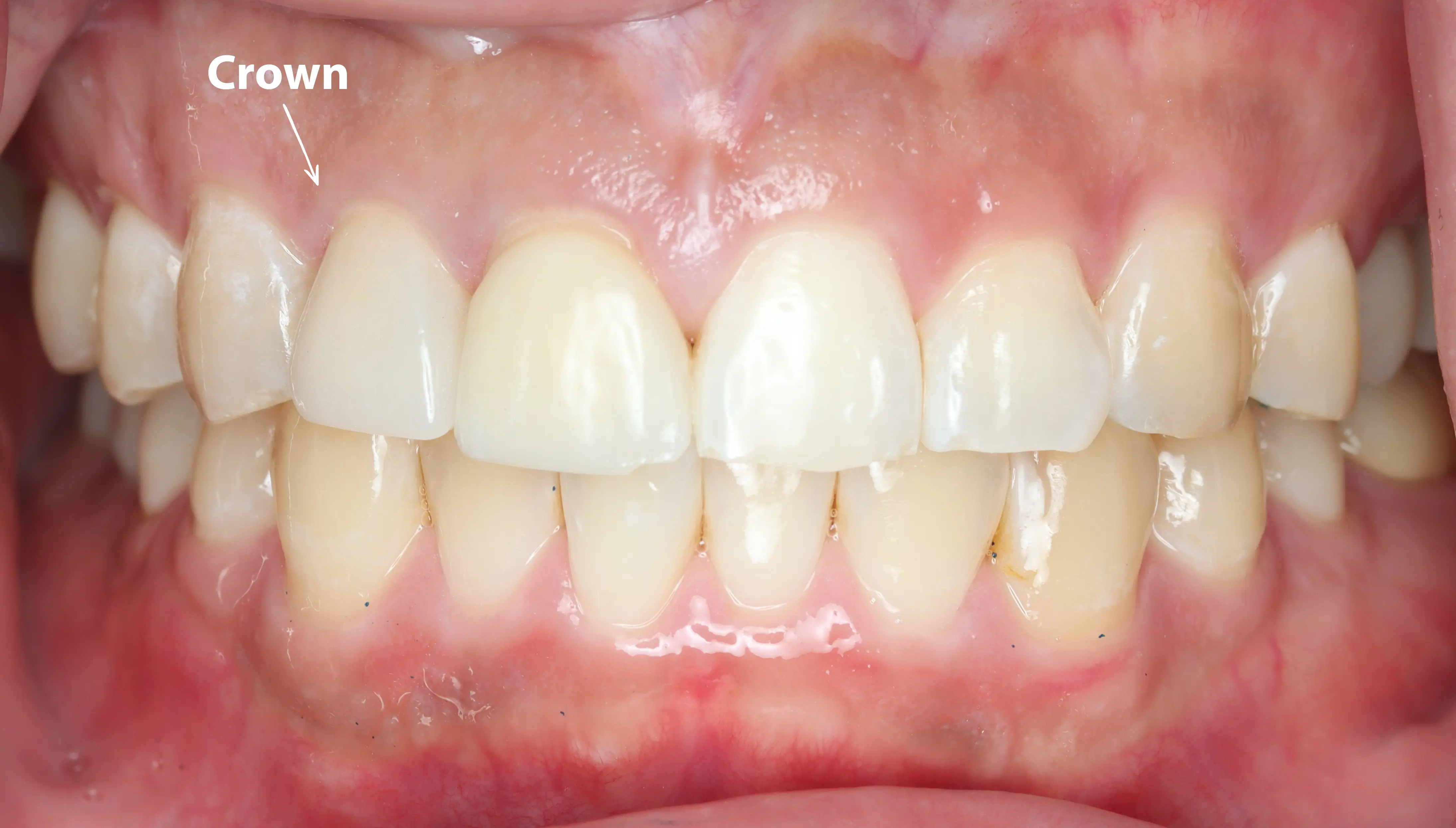 before and after dental bonding for a chipped tooth