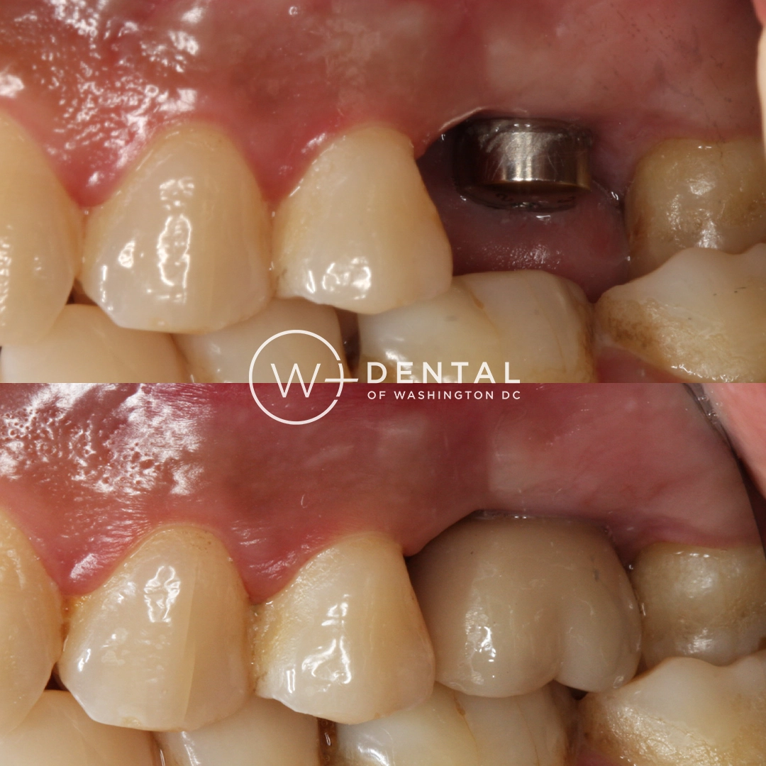 before and after dental bonding for a chipped tooth