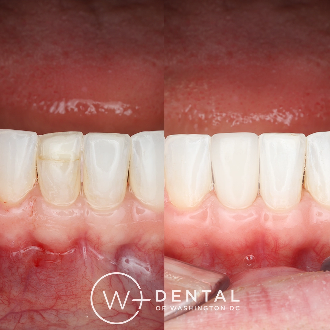 before and after dental bonding for a chipped tooth