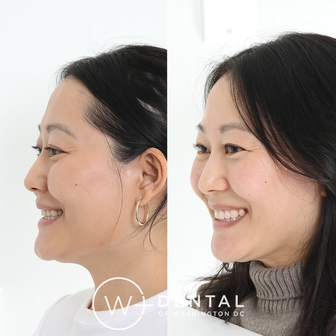 before and after dental bonding for a chipped tooth