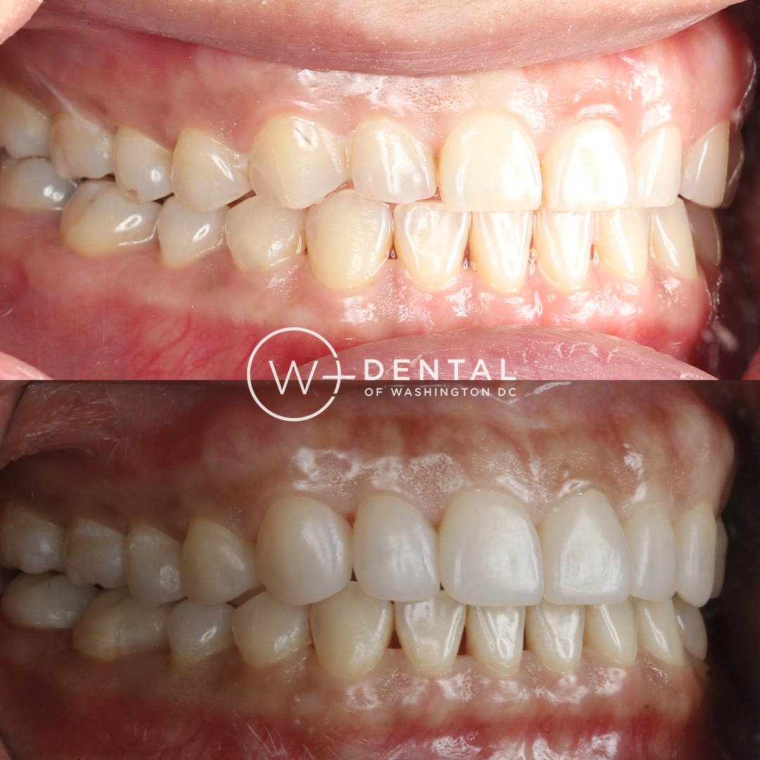 before and after dental bonding for a chipped tooth