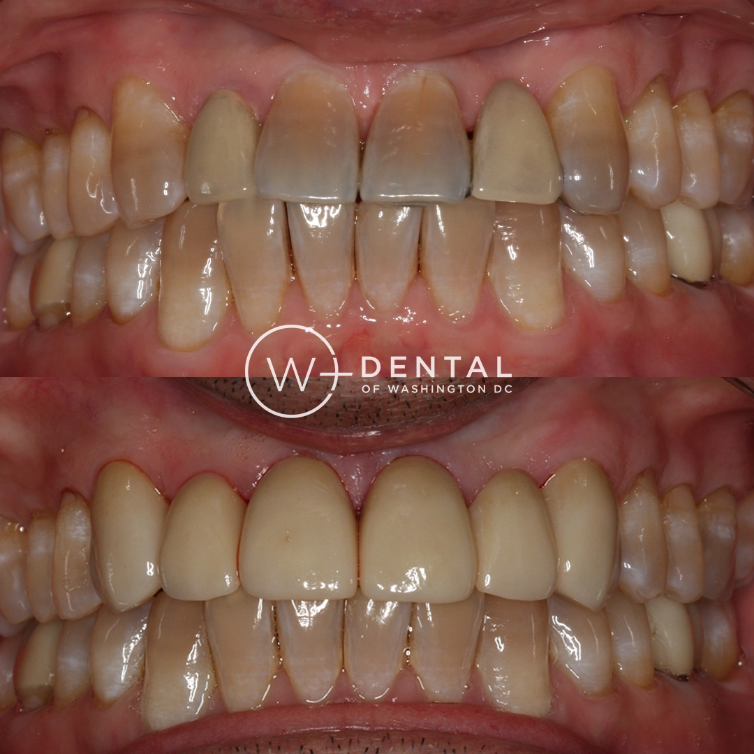 before and after dental bonding for a chipped tooth