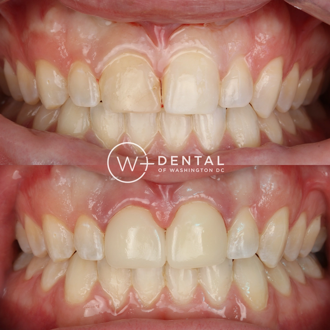 before and after dental bonding for a chipped tooth