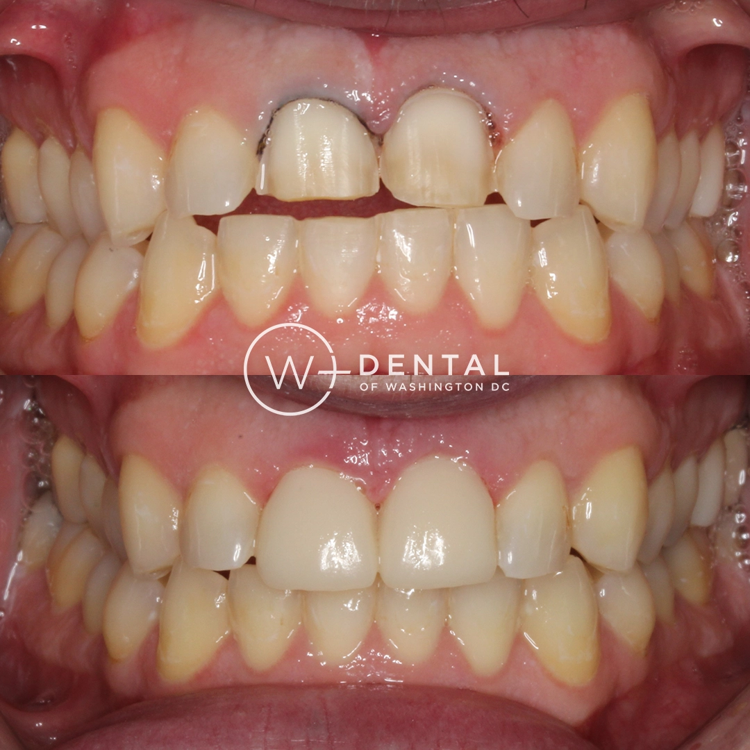 before and after dental bonding for a chipped tooth