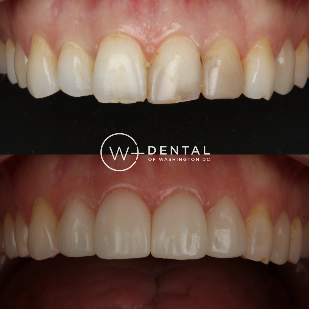 before and after dental bonding for a chipped tooth