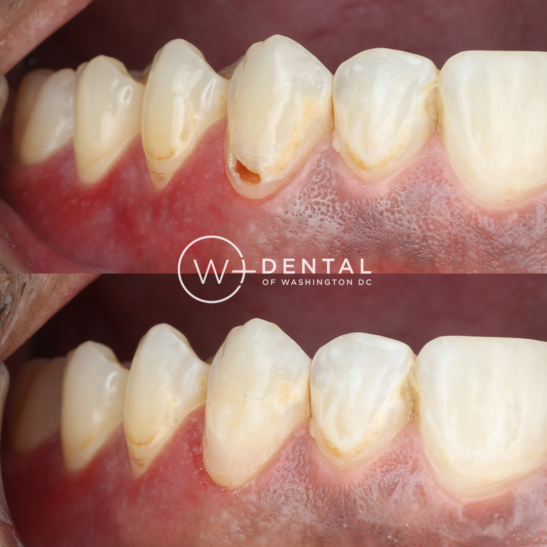 before and after dental bonding for a chipped tooth