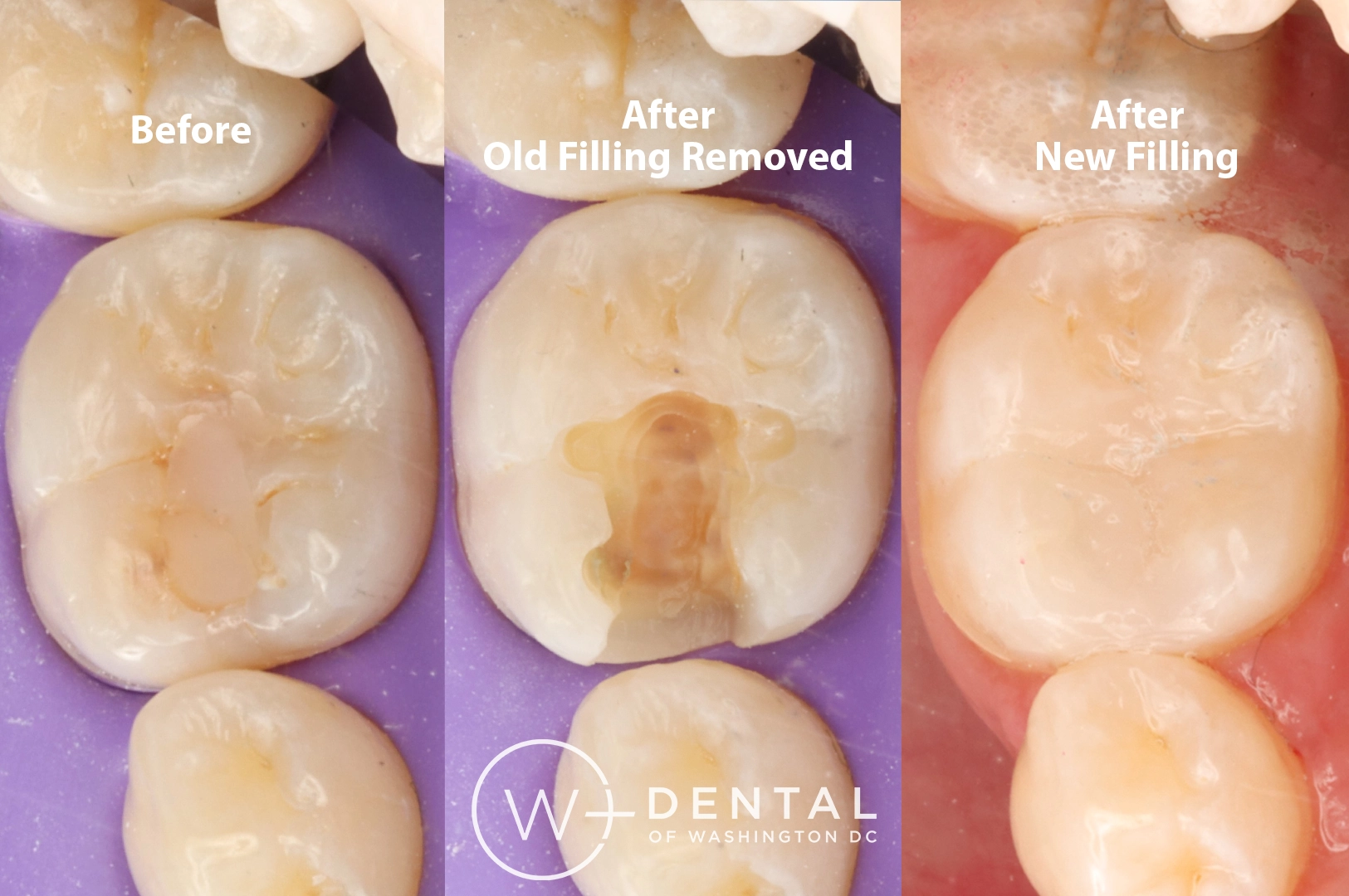 before and after dental bonding for a chipped tooth