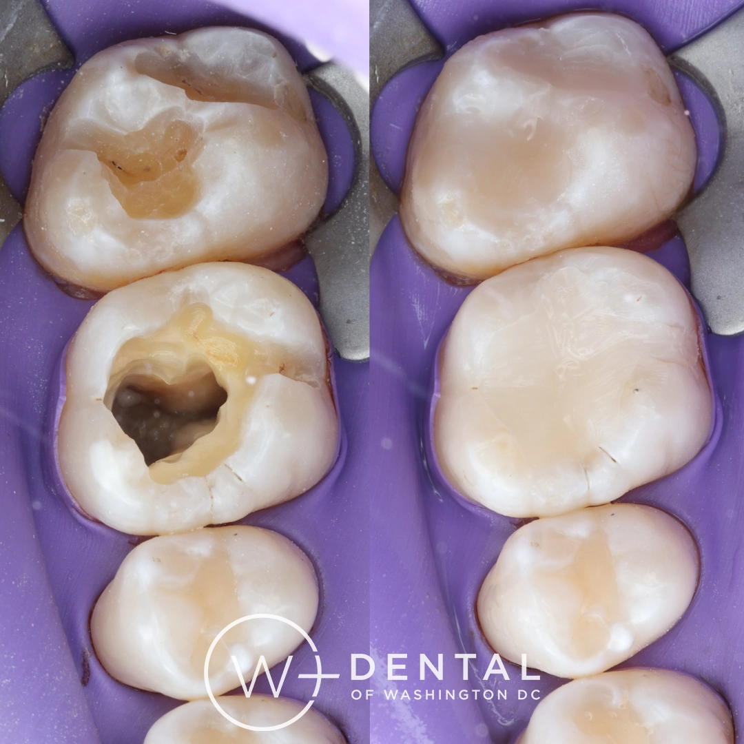 before and after dental bonding for a chipped tooth