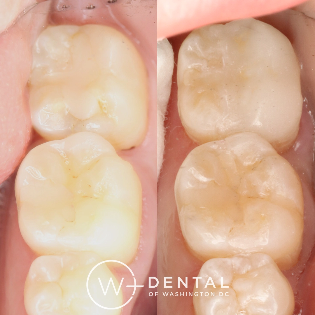 before and after dental bonding for a chipped tooth