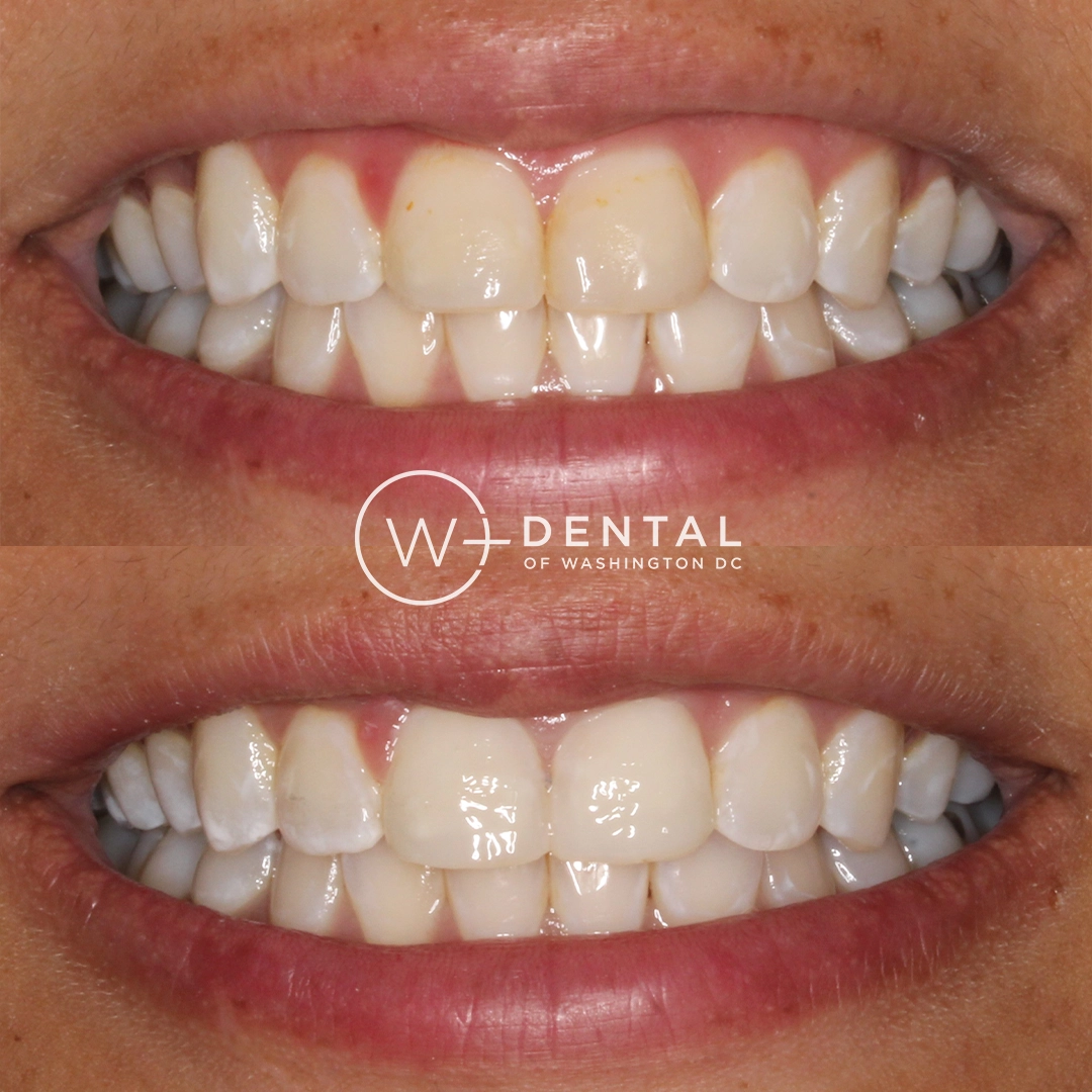 before and after dental bonding for a chipped tooth