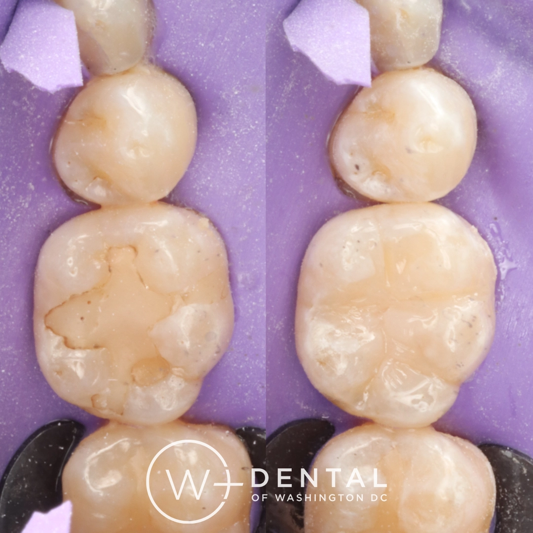 before and after dental bonding for a chipped tooth