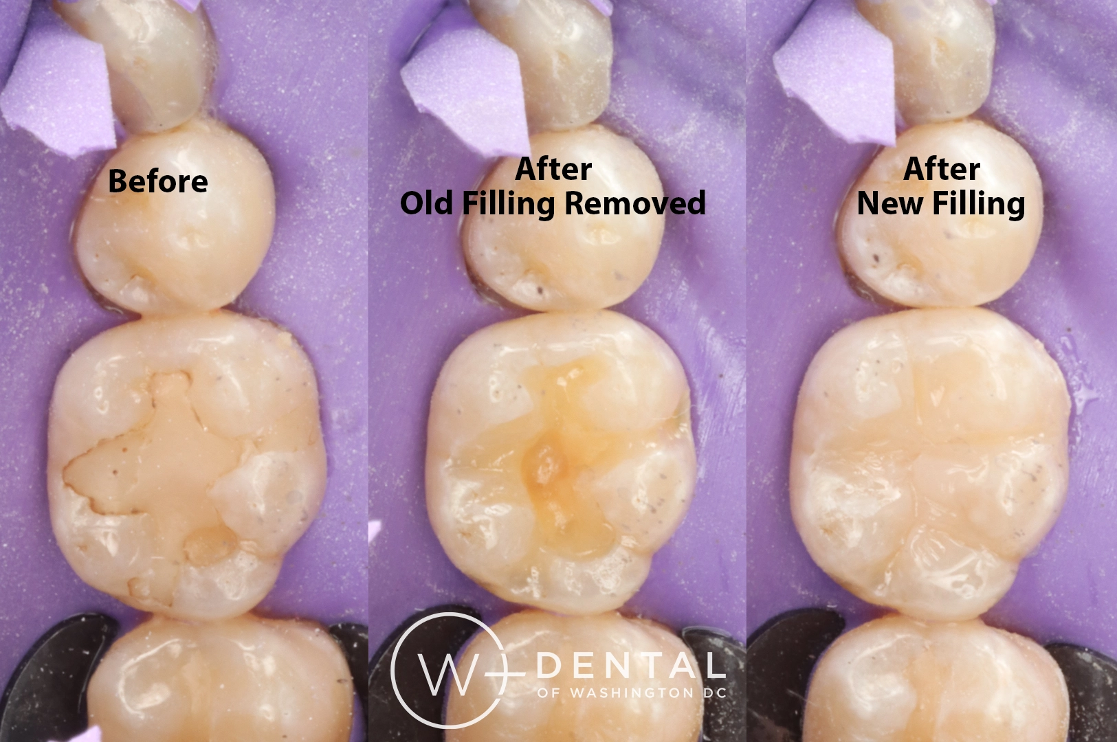 before and after dental bonding for a chipped tooth
