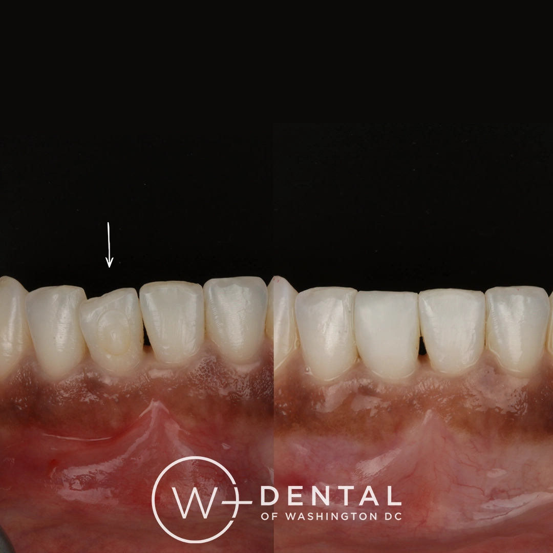 before and after dental bonding for a chipped tooth