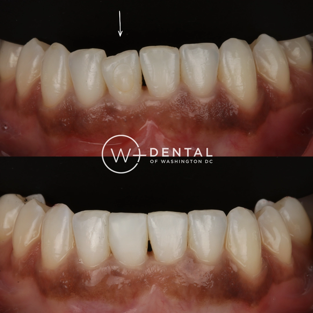 before and after dental bonding for a chipped tooth