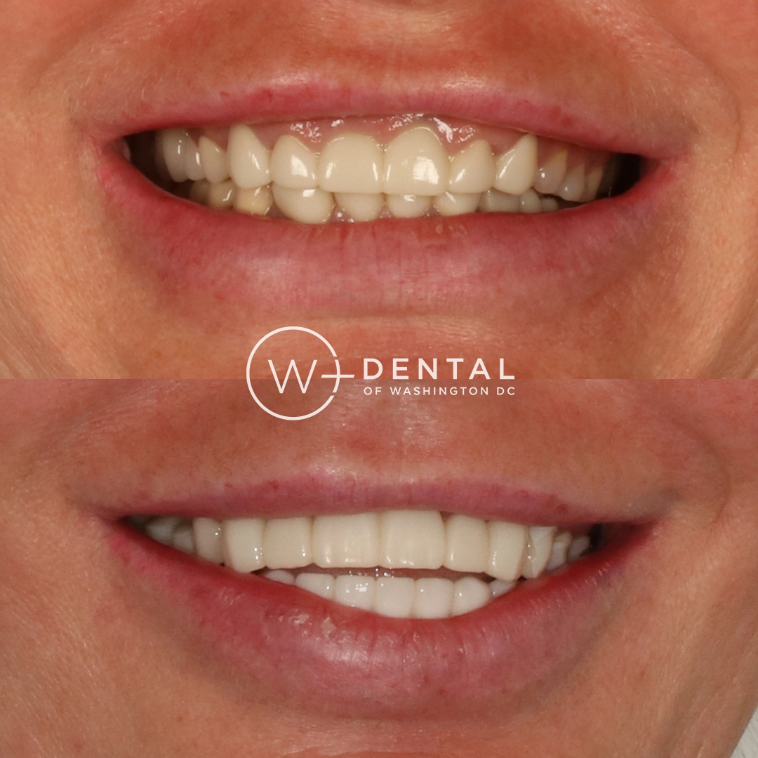 before and after dental bonding for a chipped tooth