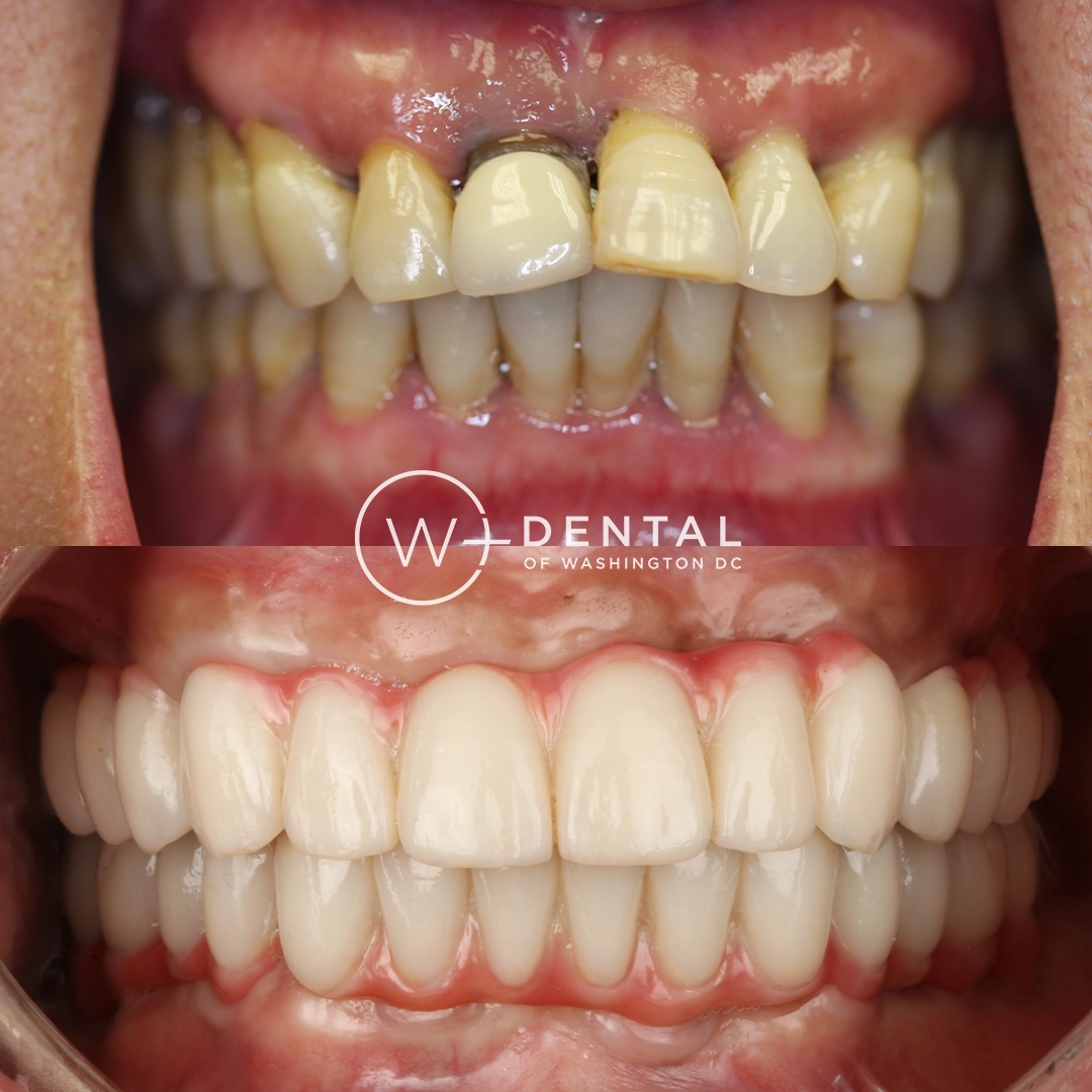 before and after dental bonding for a chipped tooth