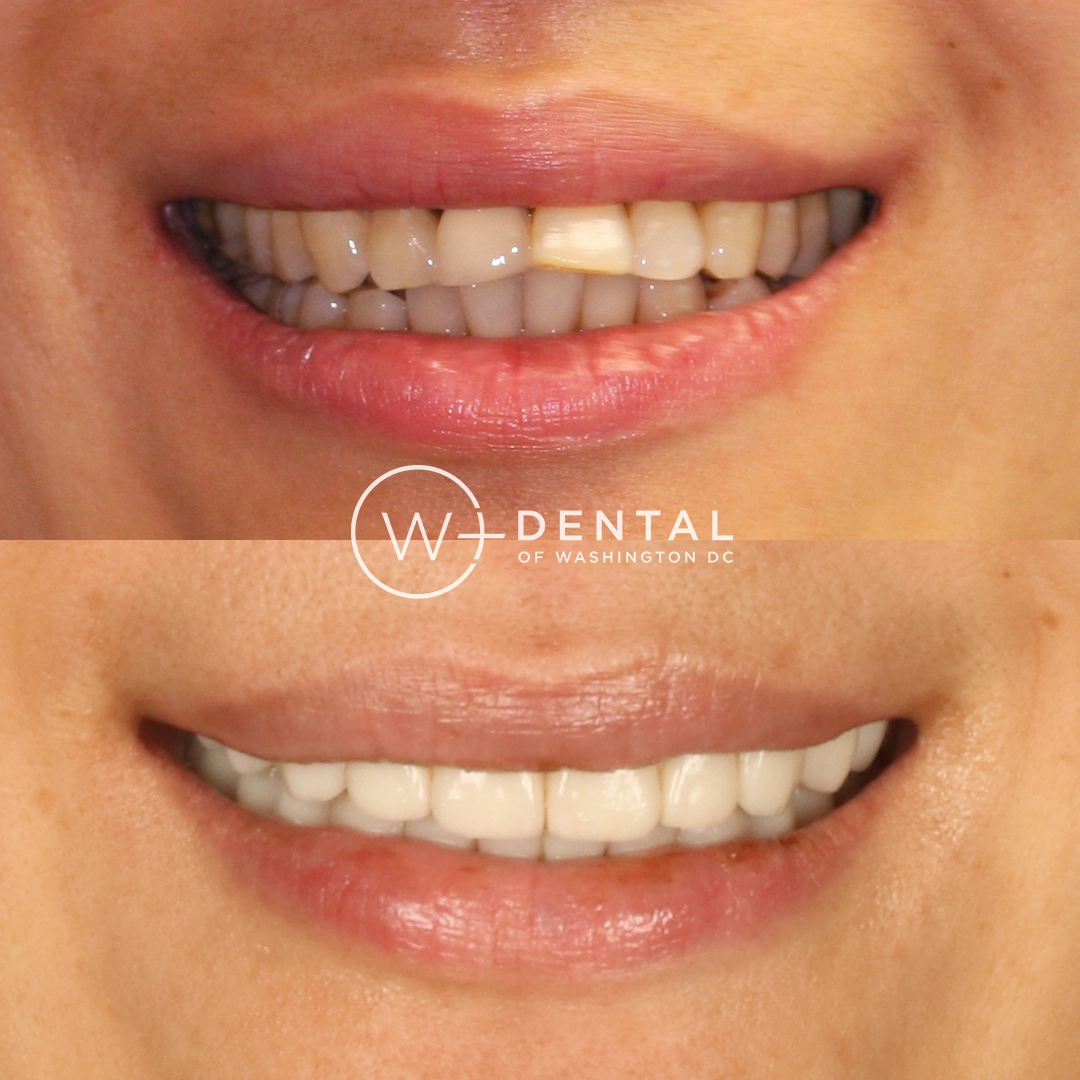 before and after dental bonding for a chipped tooth