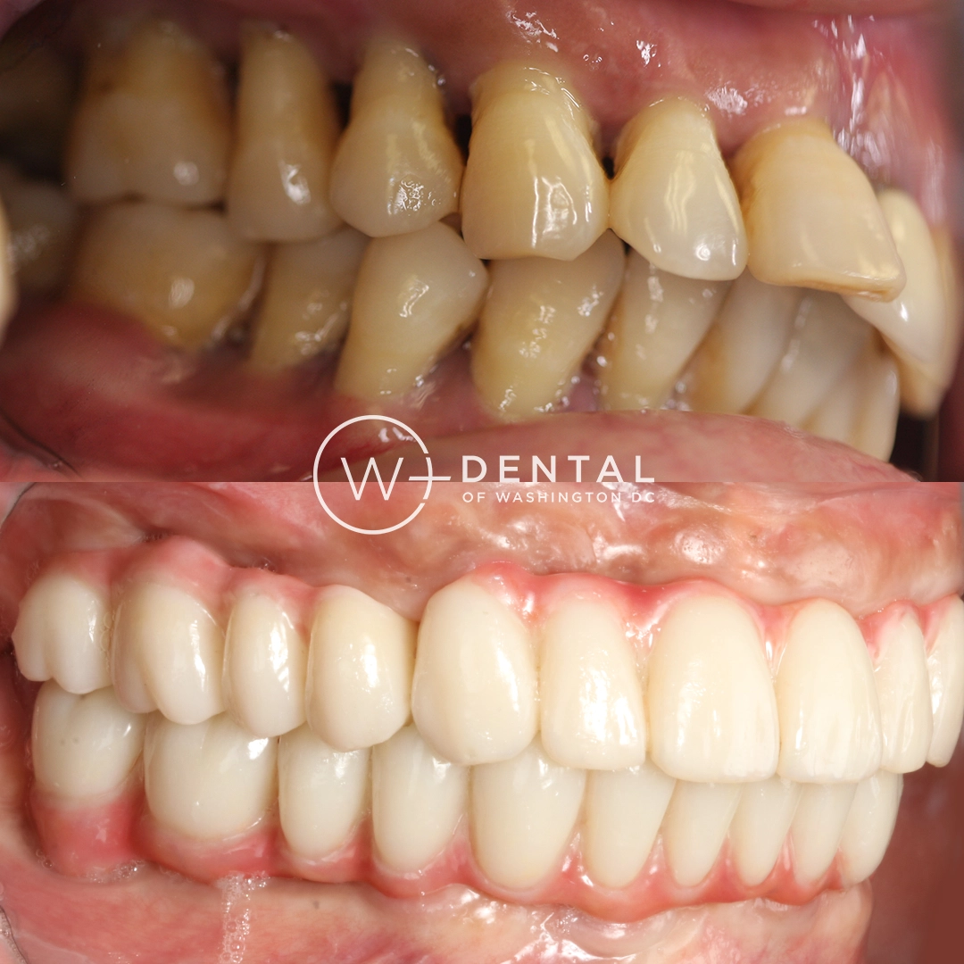 before and after dental bonding for a chipped tooth
