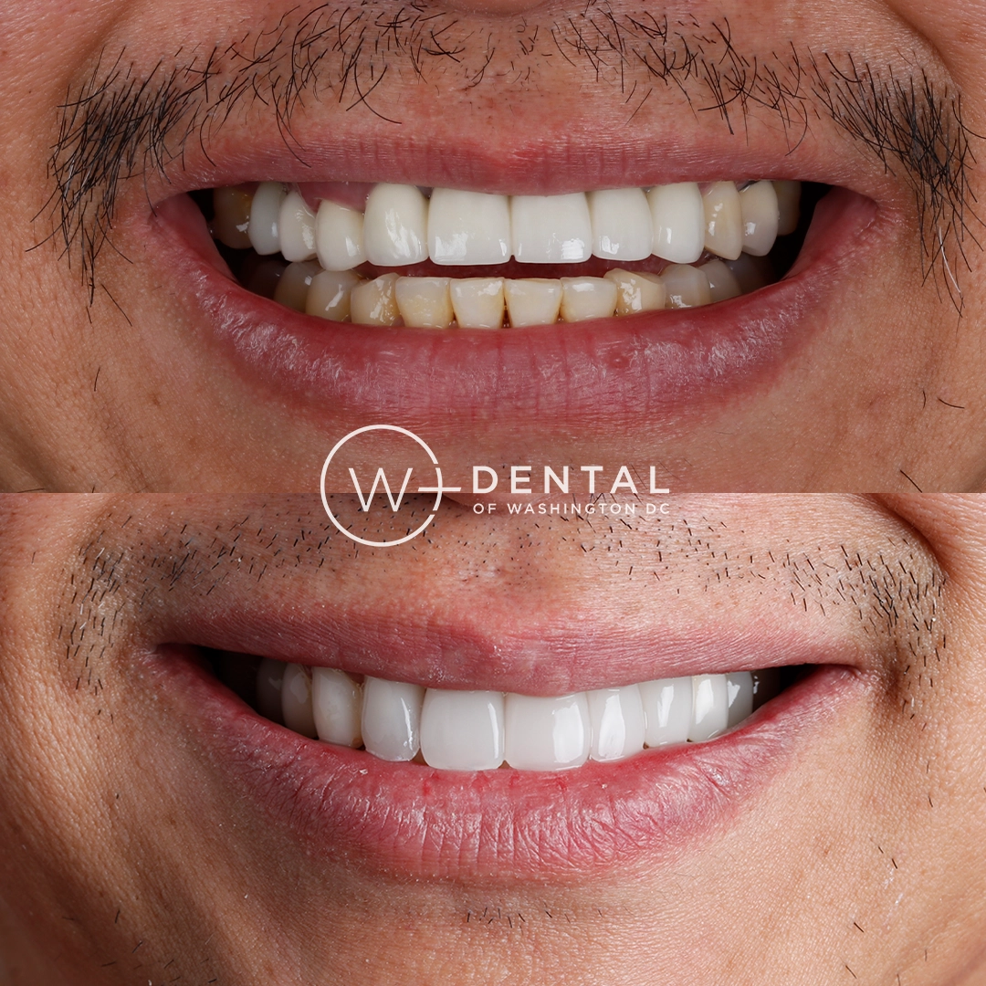 before and after dental bonding for a chipped tooth