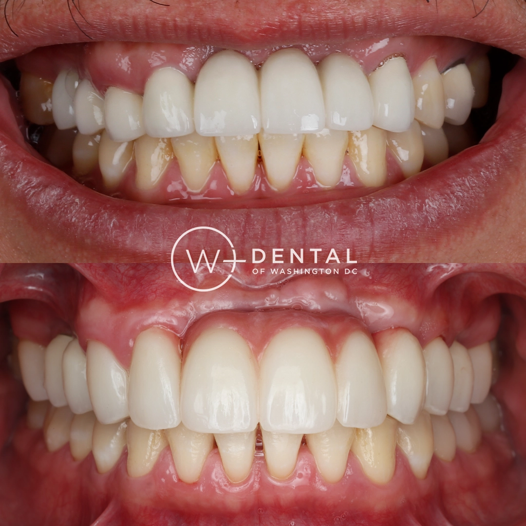before and after dental bonding for a chipped tooth