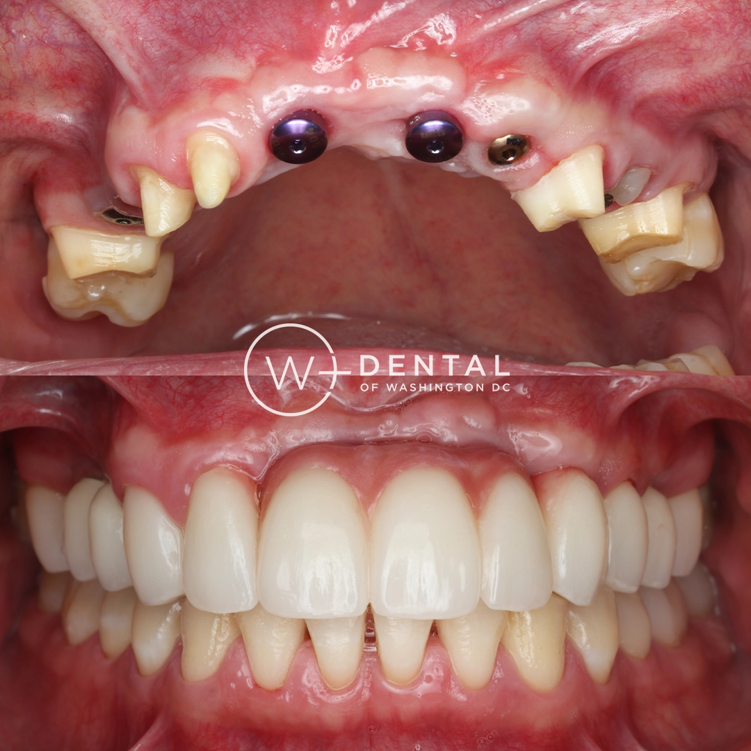 before and after dental bonding for a chipped tooth