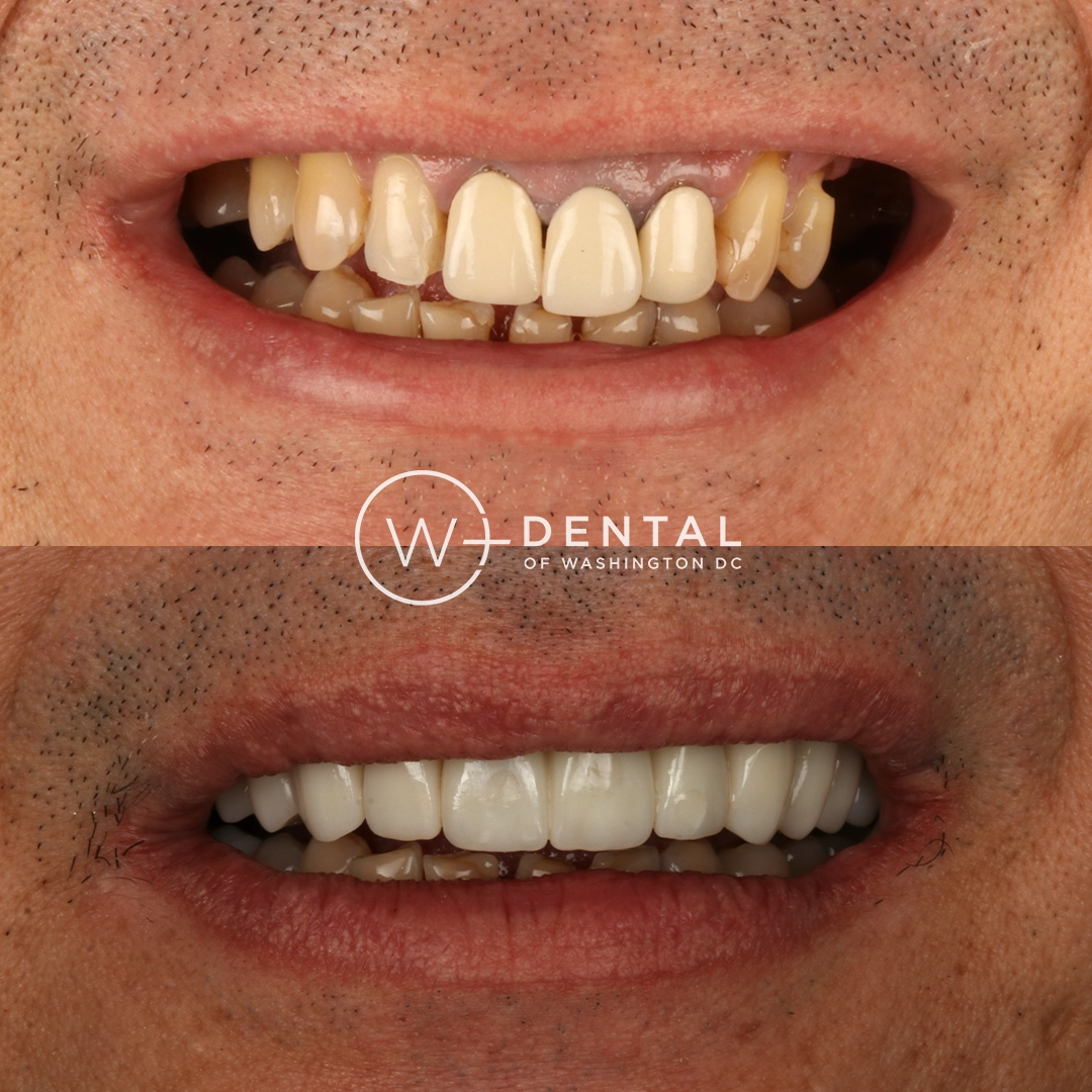 before and after dental bonding for a chipped tooth